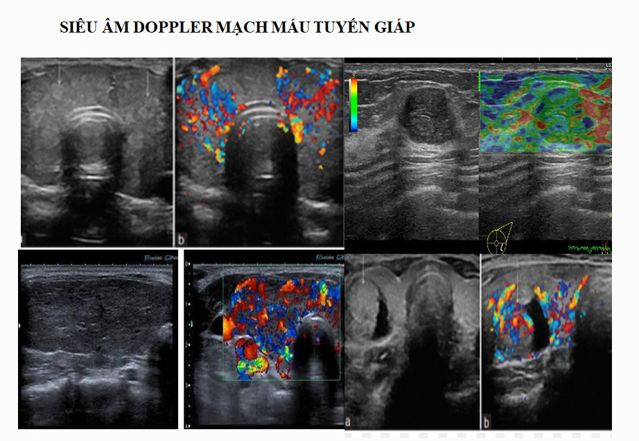 Siêu âm Doppler tuyến giáp: Phương pháp chẩn đoán an toàn và hiệu quả