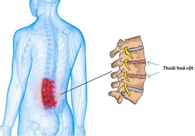 CHUYÊN GIA TƯ VẤN ĂN GÌ TỐT CHO BỆNH THOÁI HÓA CỘT SỐNG LƯNG?