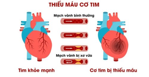 trieu-chung-thieu-mau-co-tim.jpg