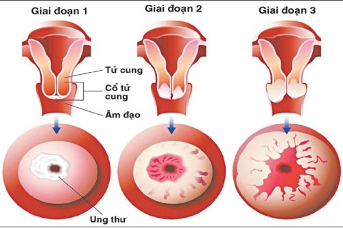 ung-thu-co-tu-cung-giai-doan-dau.jpg