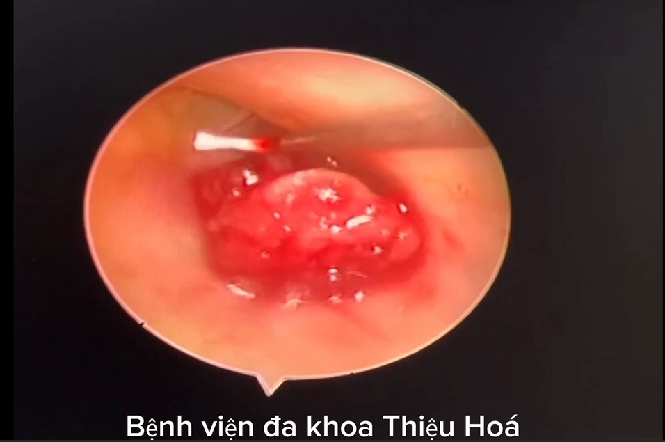 PHẪU THUẬT NỘI SOI CẮT POLYP ỐNG TAI CHO BỆNH NHÂN NỮ 72 TUỔI – GIẢI QUYẾT DỨT ĐIỂM TÌNH TRẠNG VIÊM TAI TÁI PHÁT
