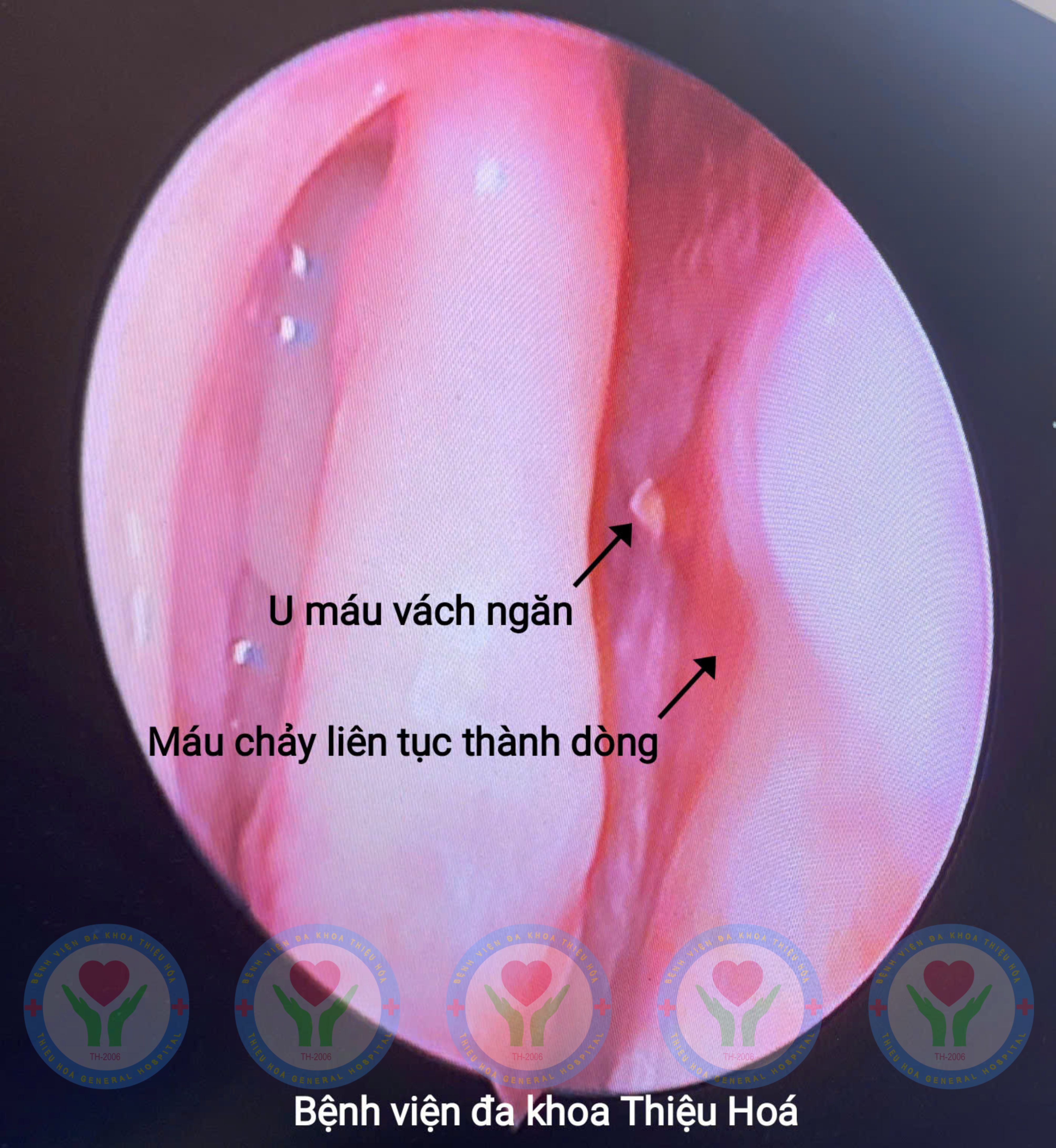 Phẫu thuật nội soi thành công u máu vách ngăn mũi – Cầm máu triệt để, hồi phục nhanh chóng