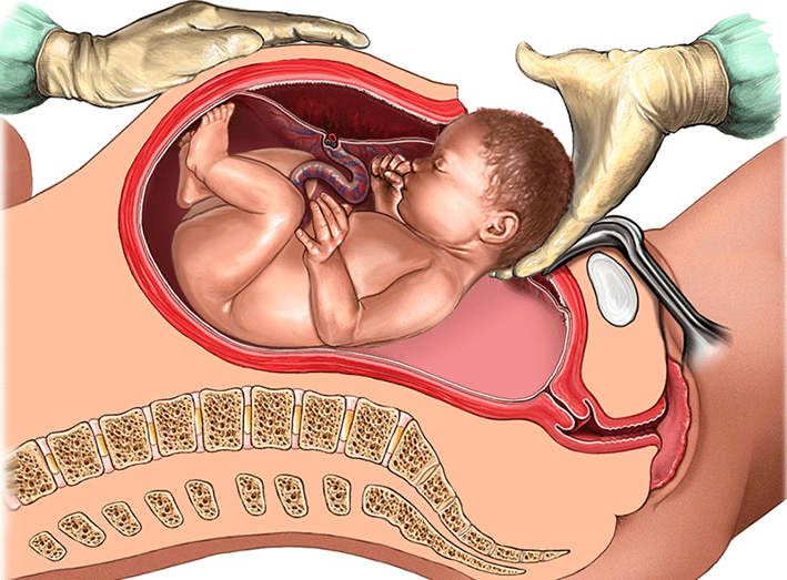 NHỮNG NGUY HIỂM TIỀM ẨN TỪ “VẾT MỔ ĐẺ CŨ”
