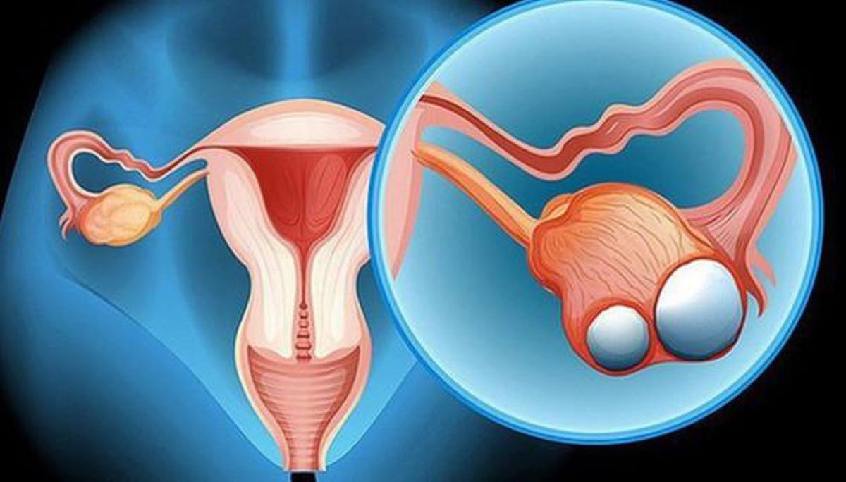 (KỊCH TÍNH) PHẪU THUẬT LOẠI BỎ U BÌ BUỒNG TRỨNG CỨU SẢN PHỤ QUA NGUY HIỂM