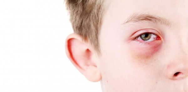 (NGUY HIỂM) BÙNG PHÁT DỊCH ĐAU MẮT ĐỎ THỜI ĐIỂM GIAO MÙA