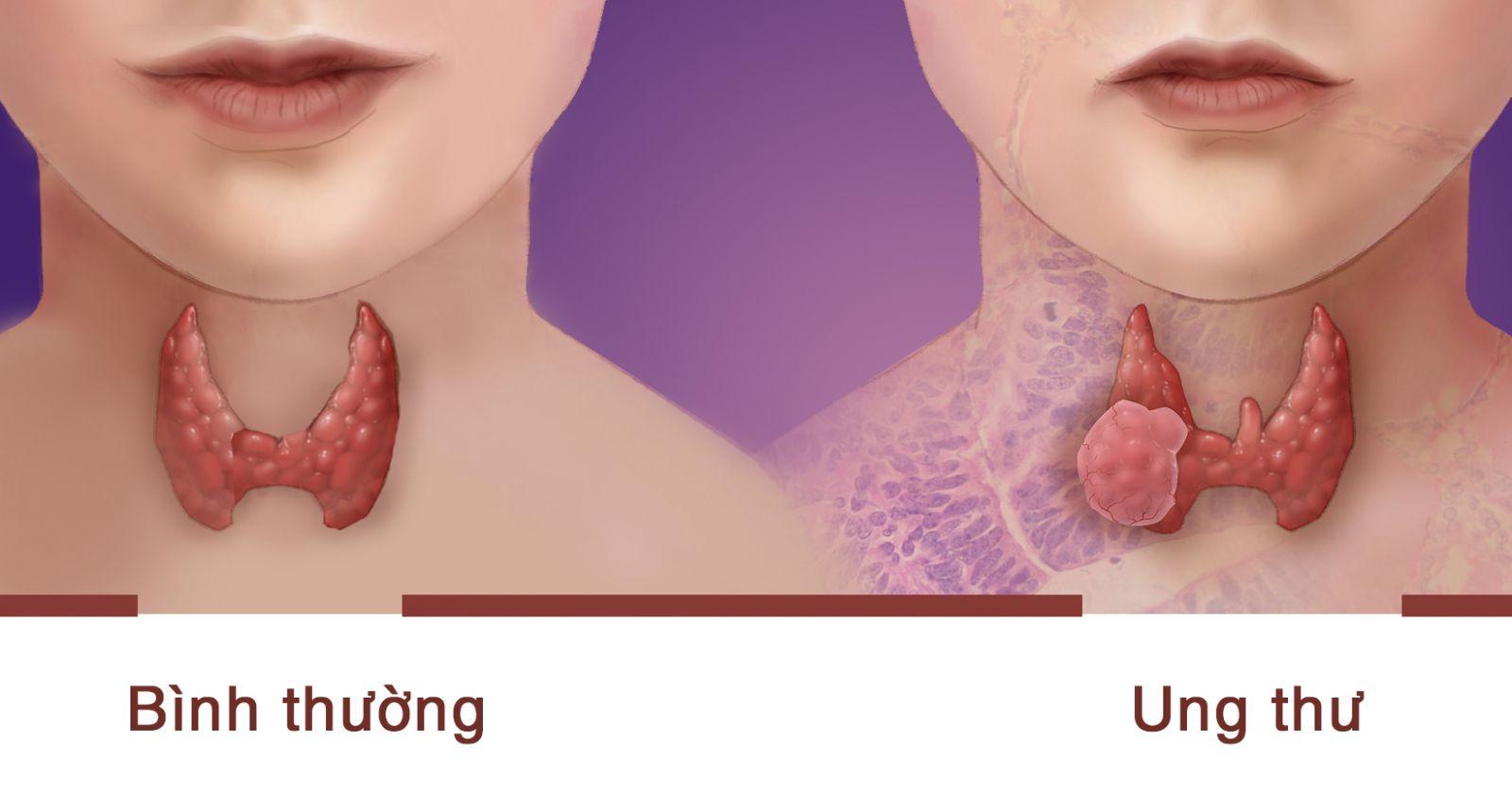 PHÁT HIỆN UNG THƯ TUYẾN GIÁP HỖ TRỢ ĐIỀU TRỊ