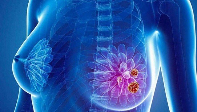 6 DẤU HIỆU CẦN BIẾT VỀ UNG THƯ VÚ GIAI ĐOẠN ĐẦU