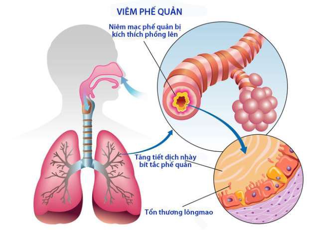 BÁC SĨ HƯỚNG DẪN PHÂN BIỆT VIÊM PHẾ QUẢN VÀ VIÊM HỌNG Ở TRẺ EM