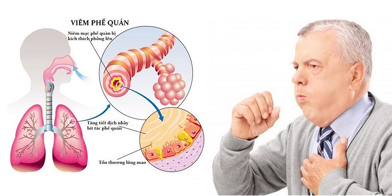 HO KÉO DÀI KHI NÀO CẦN ĐI KHÁM BÁC SĨ?
