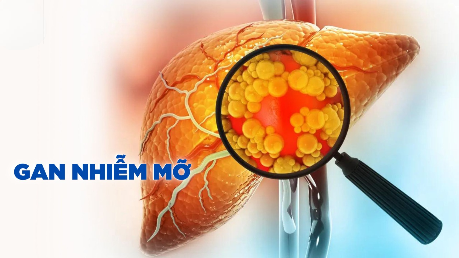  GAN NHIỄM MỠ KHÔNG DO RƯỢU LÀ GÌ, AI DỄ MẮC?