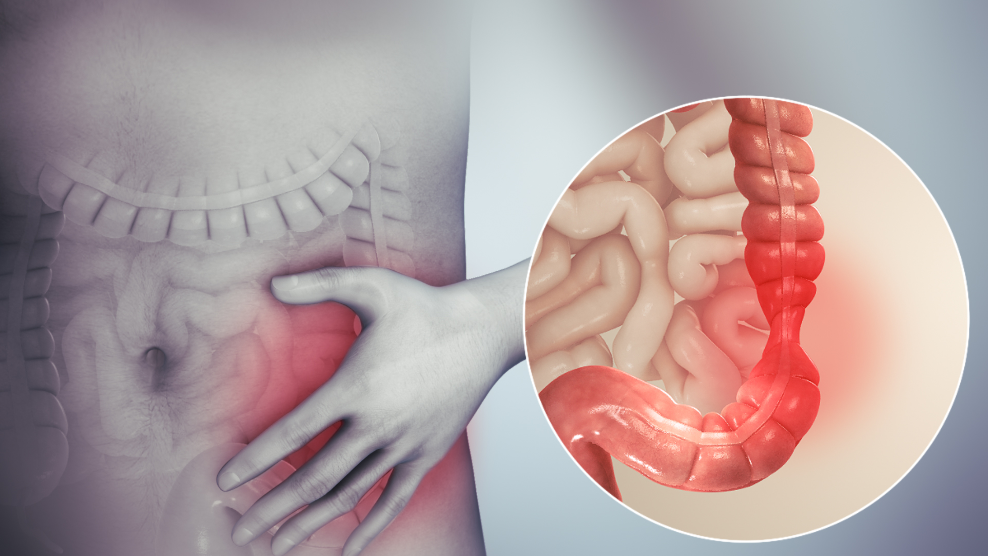 CẢI THIỆN HỘI CHỨNG RUỘT KÍCH THÍCH HIỆU QUẢ