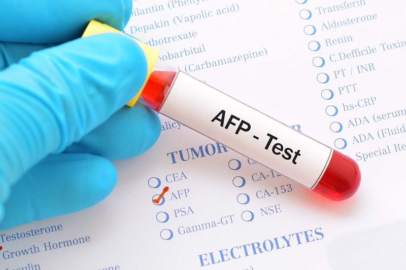 BVĐK THIỆU HÓA THỰC HIỆN XÉT NGHIỆM AFP HỖ TRỢ CHẨN ĐOÁN UNG THƯ GAN