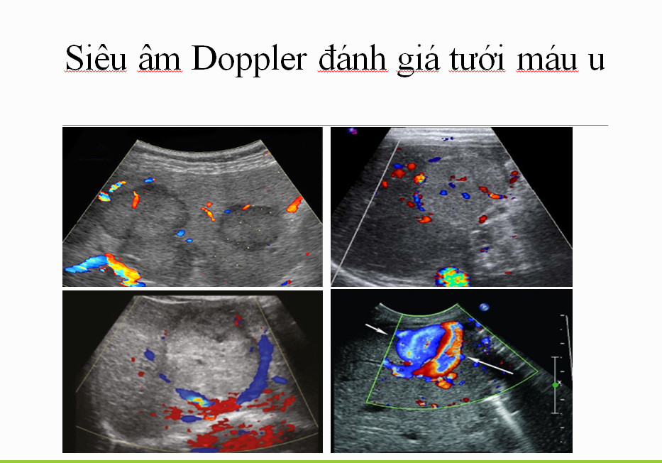 THỰC HIỆN SIÊU ÂM DOPPLER ĐÁNH GIÁ CÁC BỆNH LÝ NGUY HIỂM