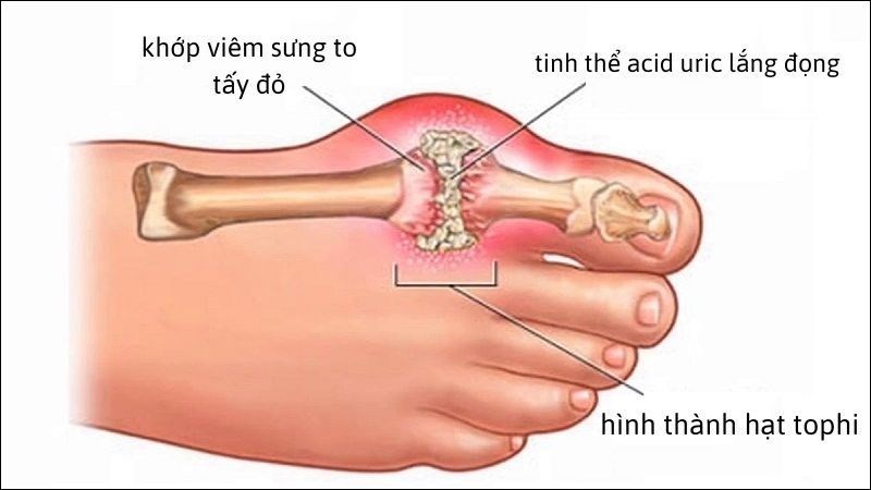 gout-1-800x450-1.jpg