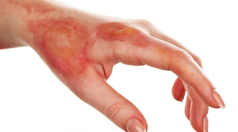 BVĐK THIỆU HÓA ĐIỀU TRỊ ỔN ĐỊNH BỆNH NHÂN BỊ BỎNG ĐỘ IV (8%)