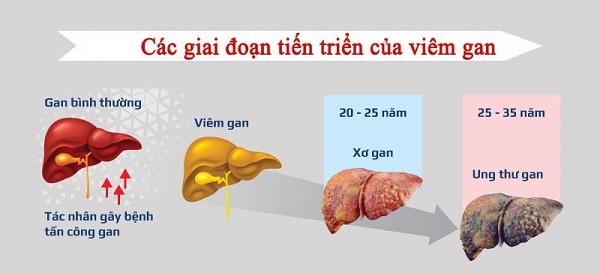 viem-gan-b-co-chua-khoi-khong-1.jpg