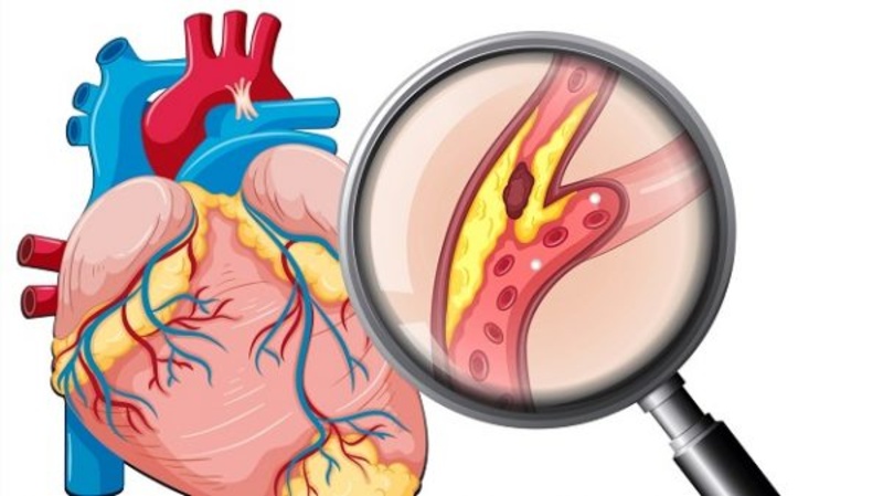 BỆNH MẠCH VÀNH BIỂU HIỆN NHƯ THẾ NÀO?