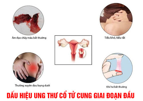 60fba27fa820ceecdedfc304_dau-hieu-ung-thu-co-tu-cung-giai-doan-dau (1).jpg