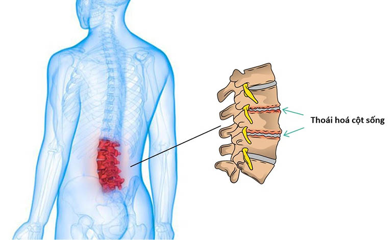 CHUYÊN GIA TƯ VẤN ĂN GÌ TỐT CHO BỆNH THOÁI HÓA CỘT SỐNG LƯNG?