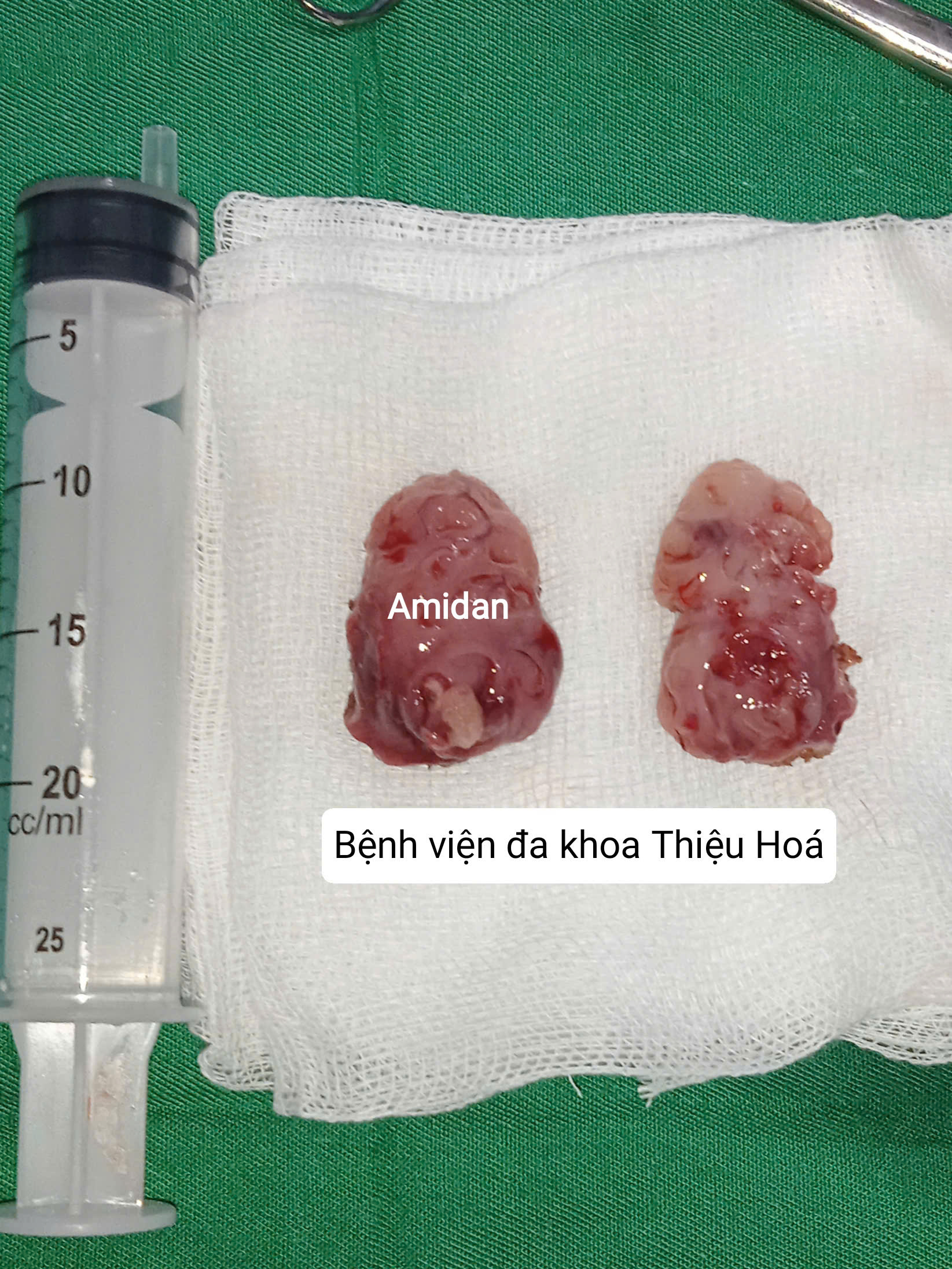CẮT AMIDAN – GIẢI PHÁP CHO TRẺ NGỦ NGÁY, NGỪNG THỞ KHI NGỦ