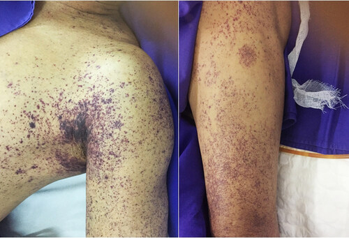 Cảnh báo: Bệnh liên cầu lợn đang có xu hướng gia tăng, tiềm ẩn nhiều nguy hiểm cho sức khỏe